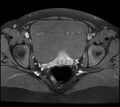 Adenomyosis - ovarian endometriomas (Radiopaedia 67031-76350 Axial T1 C+ fat sat 19).jpg