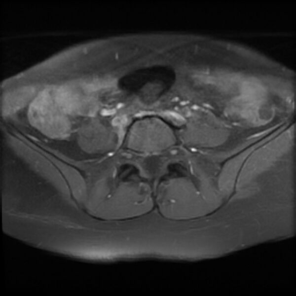 File:Adenomyosis within a septate uterus (Radiopaedia 69963-79981 Axial T1 C+ fat sat 3).jpg