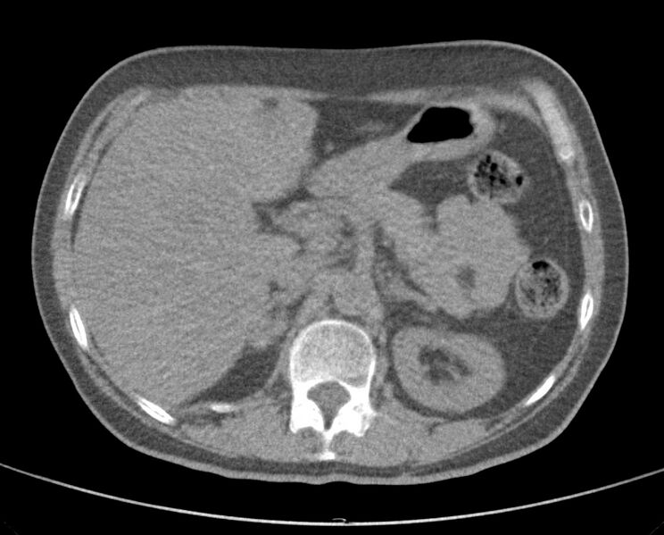 File:Adenosquamous lung carcinoma (Radiopaedia 22035-22030 non-contrast 62).jpg