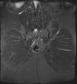 Adnexal multilocular cyst (O-RADS US 3- O-RADS MRI 3) (Radiopaedia 87426-103754 Coronal T2 fat sat 29).jpg