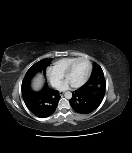 File:Adrenal cortical carcinoma with IVC invasion and thrombosis (Radiopaedia 34307-35597 Axial C+ portal venous phase 4).jpg