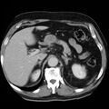 Adrenal hemangioma (Radiopaedia 11039-11445 Axial C+ portal venous phase 5).jpg