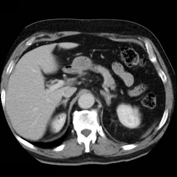 File:Adrenal hemangioma (Radiopaedia 11039-11445 Axial C+ portal venous phase 5).jpg