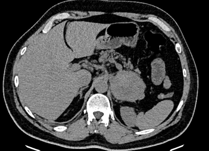 Adrenal metastases (Radiopaedia 73082-83791 Axial non-contrast 46).jpg
