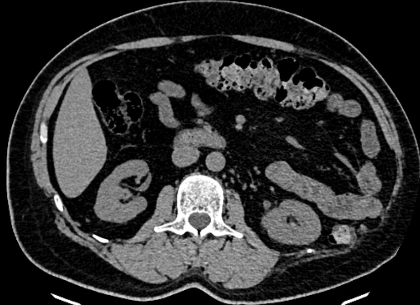 Adrenal metastases (Radiopaedia 73082-83791 Axial non-contrast 83).jpg