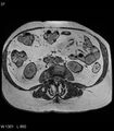 Adrenal myelolipoma (Radiopaedia 6765-7961 Axial T1 out-of-phase 37).jpg