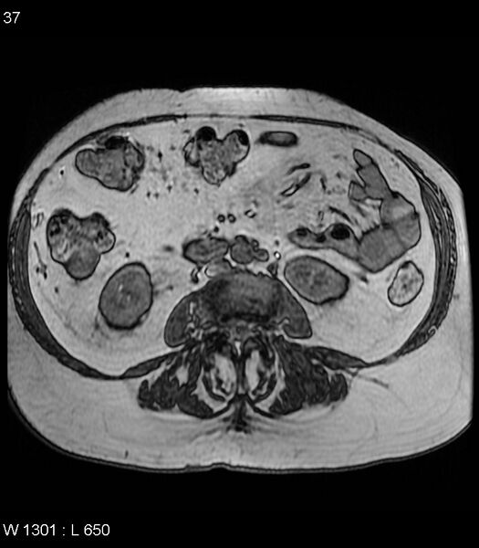 File:Adrenal myelolipoma (Radiopaedia 6765-7961 Axial T1 out-of-phase 37).jpg
