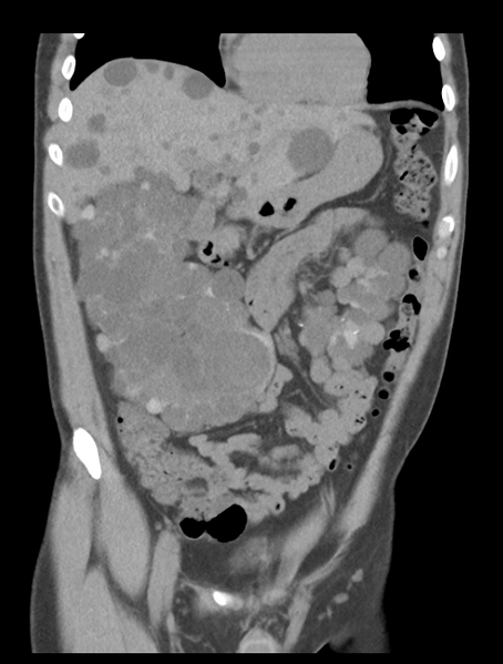 File:Adult polycystic kidney disease (Radiopaedia 47866-52626 Coronal non-contrast 14).png