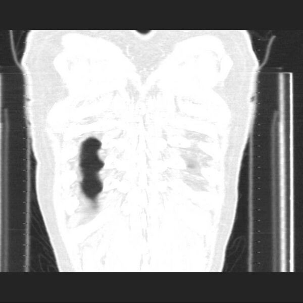 File:Allergic bronchopulmonary aspergillosis (Radiopaedia 21386-21320 Coronal lung window 18).jpg
