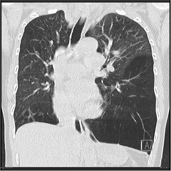 File:Alpha-1-antitrypsin deficiency (Radiopaedia 26537-26678 Coronal lung window 16).jpg
