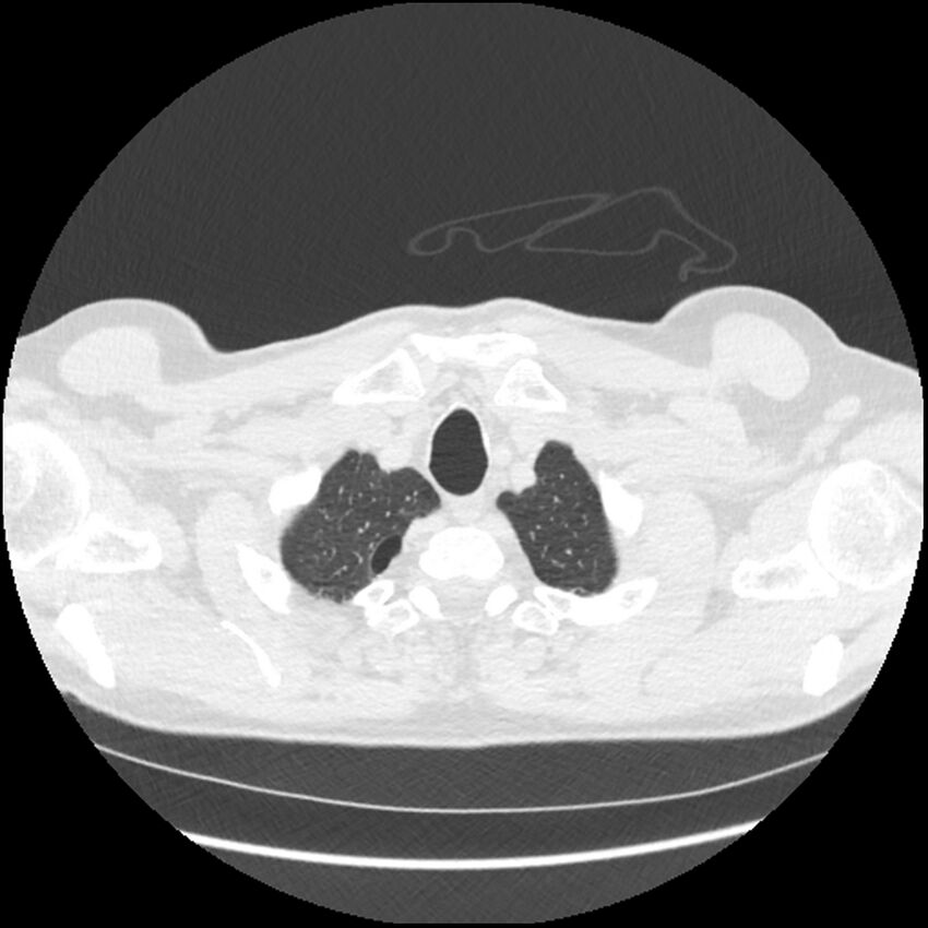 Alpha-1-antitrypsin deficiency (Radiopaedia 40993-43722 Axial lung window 15).jpg