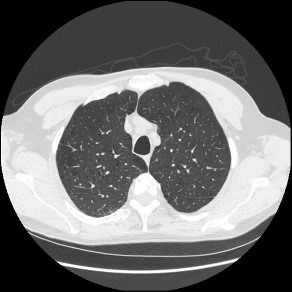 File:Alpha-1-antitrypsin deficiency (Radiopaedia 40993-43722 Axial lung window 43).jpg