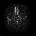 Amnestic syndrome secondary to hypoxic brain injury (Radiopaedia 24743-25004 DWI 2).jpg