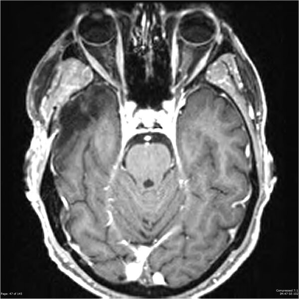 File:Anaplastic meningioma with recurrence (Radiopaedia 34452-35788 Axial T1 C+ 47).jpg