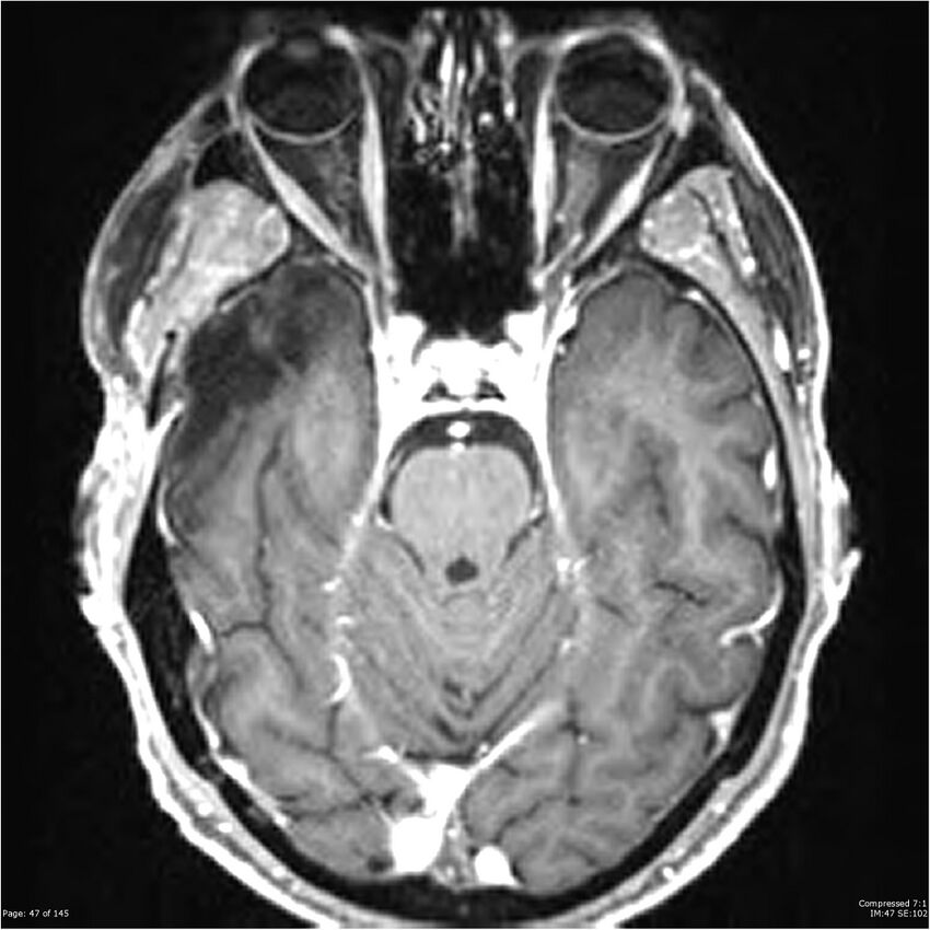 Anaplastic meningioma with recurrence (Radiopaedia 34452-35788 Axial T1 C+ 47).jpg