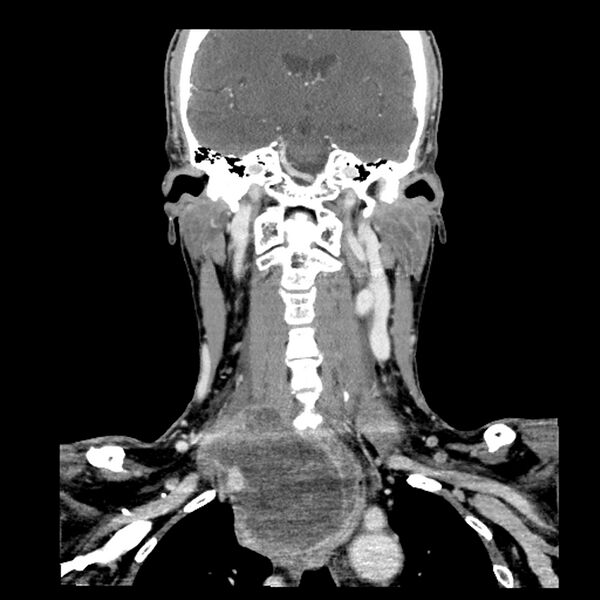 File:Anaplastic thyroid carcinoma (Radiopaedia 79087-92034 A 70).jpg