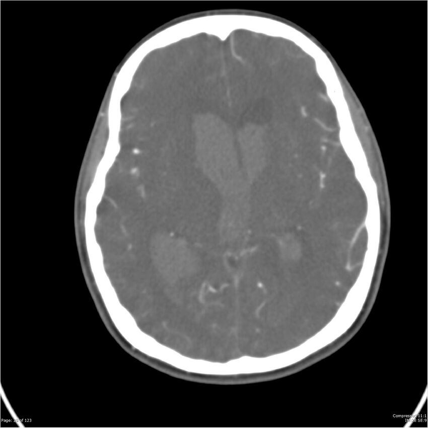 Aneurysmal subarachnoid hemorrhage and Moya Moya disease (Radiopaedia 34306-35593 Axial CT COW 28).jpg
