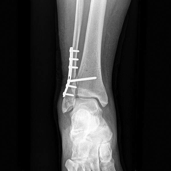 File:Ankle fracture - Weber C (post-operative) (Radiopaedia 8895-9674 Frontal 1).jpg