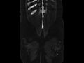 Ankylosing spondylitis (Radiopaedia 44609-48357 Coronal bone window 102).jpg