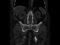 Ankylosing spondylitis (Radiopaedia 44609-48357 Coronal bone window 61).jpg