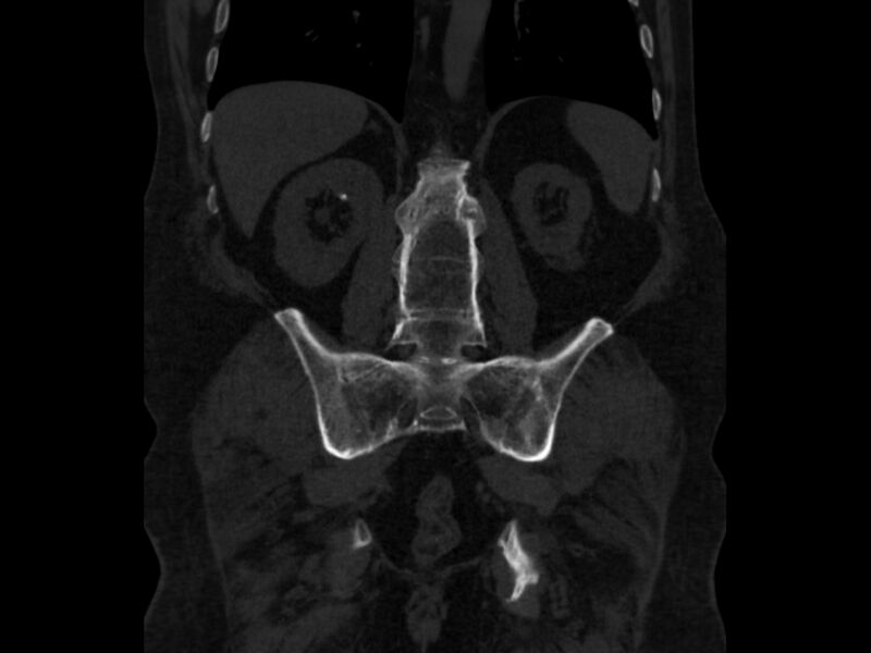 File:Ankylosing spondylitis (Radiopaedia 44609-48357 Coronal bone window 61).jpg