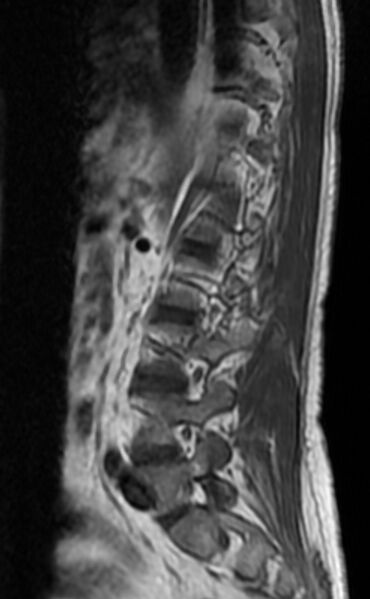 File:Ankylosing spondylitis - Andersson lesion (Radiopaedia 81878-95838 Sagittal T1 10).jpg