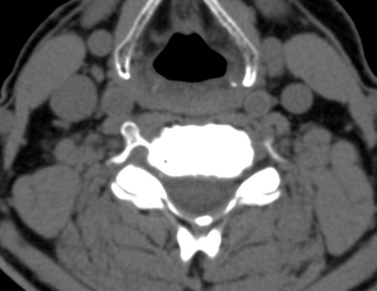 File:Anterior cervical postdiscectomy arthrodesis (Radiopaedia 32678-33646 Axial non-contrast 45).jpg