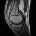 Anterior cruciate ligament tear - pediatric (Radiopaedia 62152-70260 Sagittal PD 57).jpg