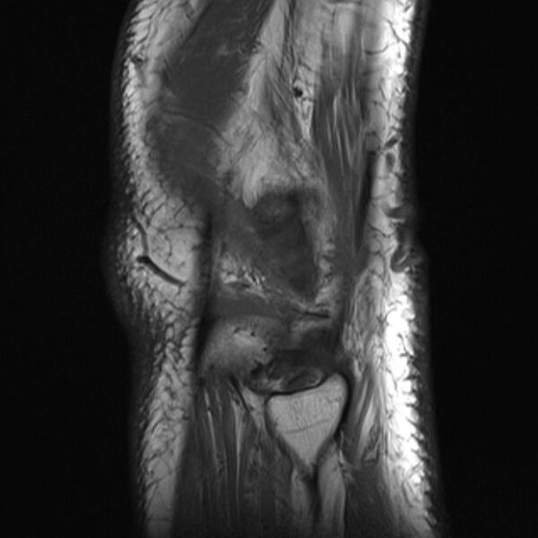 File:Anterior cruciate ligament tear - ramp lesion (Radiopaedia 71883-82322 Sagittal T1 3).jpg