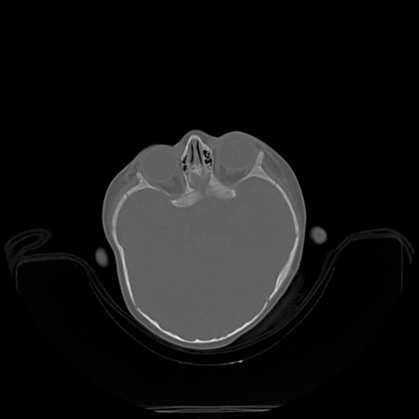 File:Anterior plagiocephaly (Radiopaedia 71836-82273 C 10).jpg