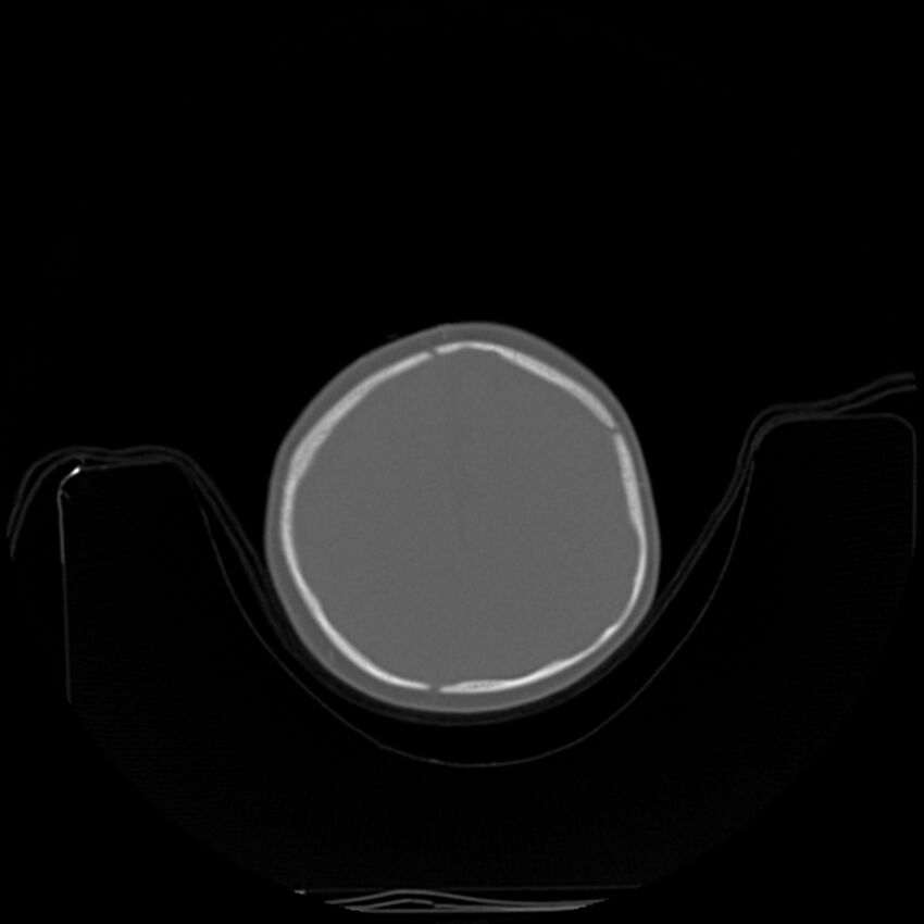 Anterior plagiocephaly (Radiopaedia 71836-82273 C 82).jpg