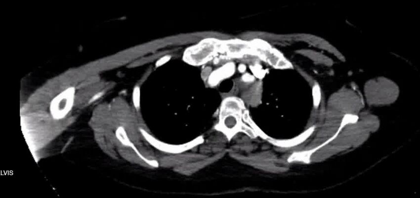 Aortic Dissection (Radiopaedia 85272-100847 A 9).jpg