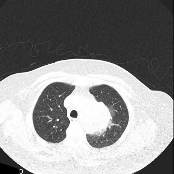 File:Aortic arch false aneurysm (Radiopaedia 14667-14587 Axial lung window 7).jpg