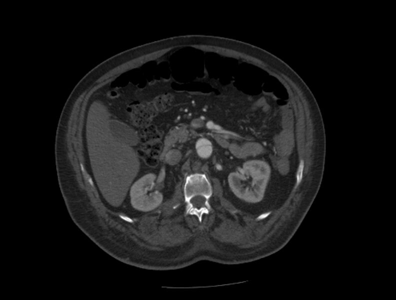 File:Aortic dissection (Radiopaedia 28802-29105 A 55).jpg