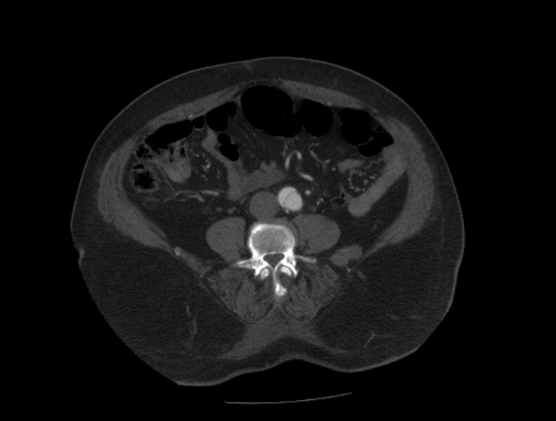 File:Aortic dissection (Radiopaedia 28802-29105 A 75).jpg