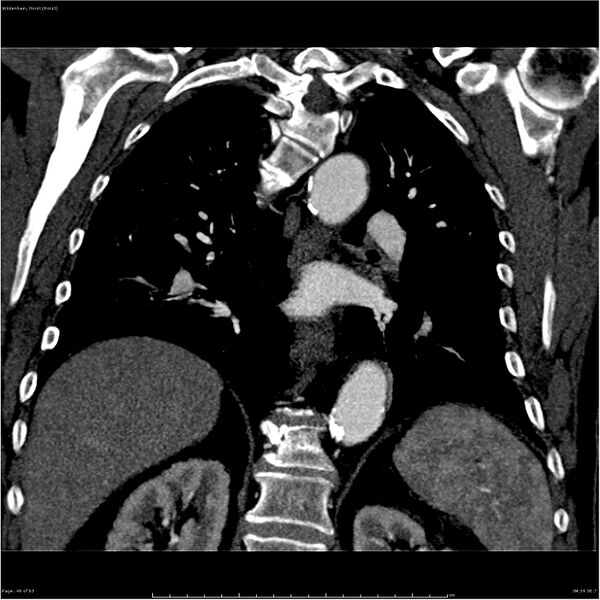 File:Aortic dissection - Stanford type A (Radiopaedia 26183-26315 A 46).jpg