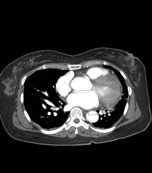 File:Aortic dissection with renal ischemia (Radiopaedia 76573-88338 A 42).jpg