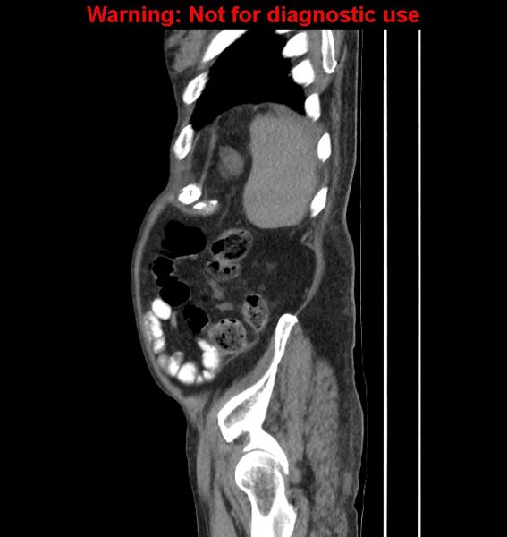 File:Aortic graft infection (Radiopaedia 44979-48907 C 12).jpg