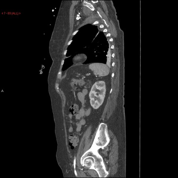 File:Aortic intramural hematoma (Radiopaedia 27746-28001 C 58).jpg