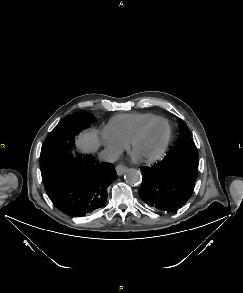 File:Aortoenteric fistula (Radiopaedia 84308-99603 Axial non-contrast 2).jpg