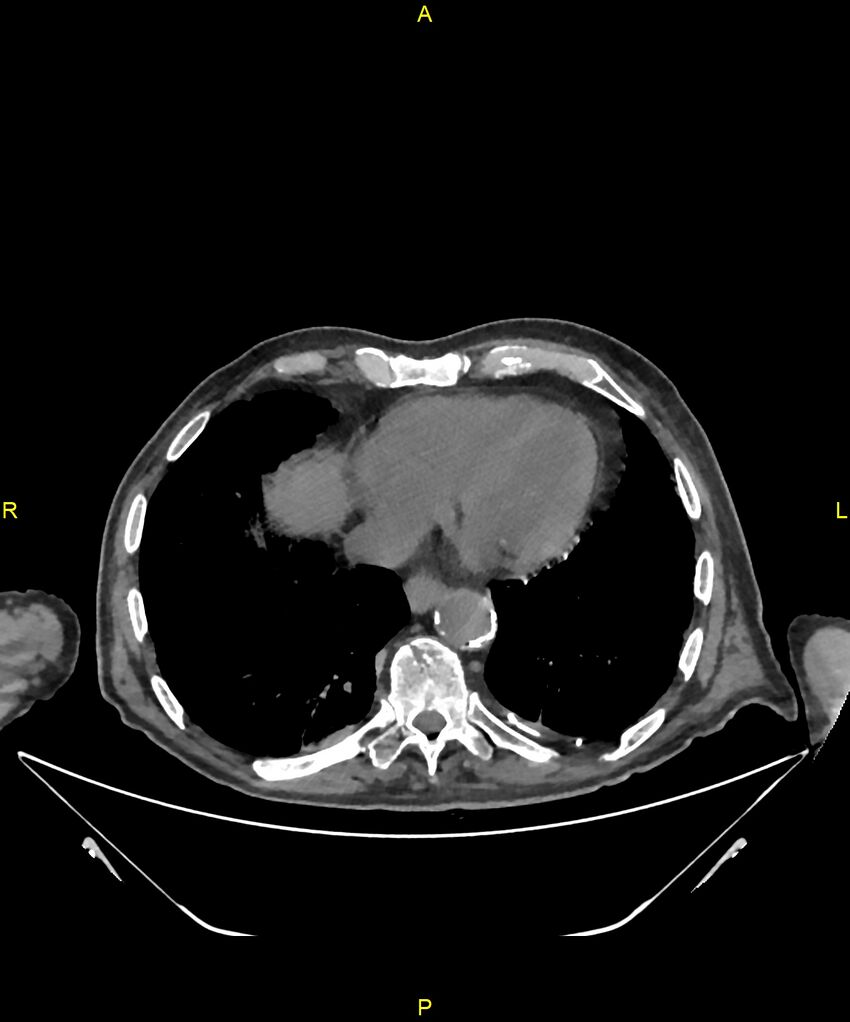 Aortoenteric fistula (Radiopaedia 84308-99603 Axial non-contrast 2).jpg