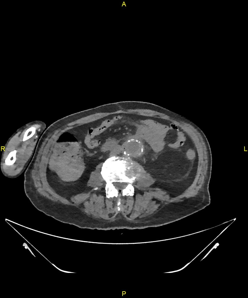 Aortoenteric fistula (Radiopaedia 84308-99603 Axial non-contrast 202).jpg