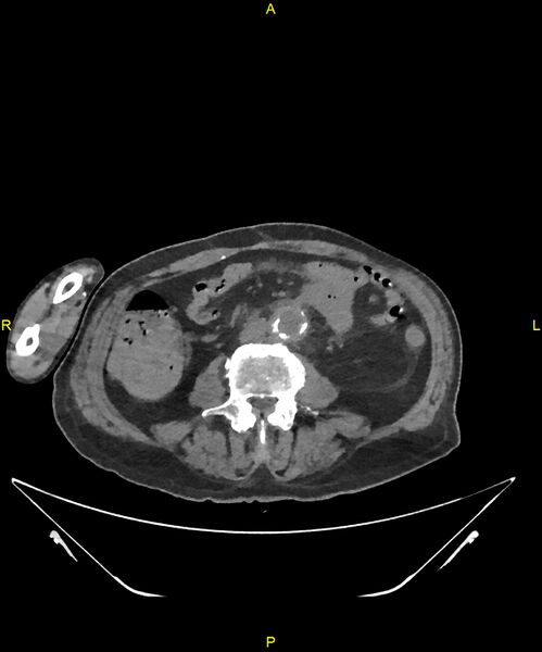 File:Aortoenteric fistula (Radiopaedia 84308-99603 Axial non-contrast 207).jpg