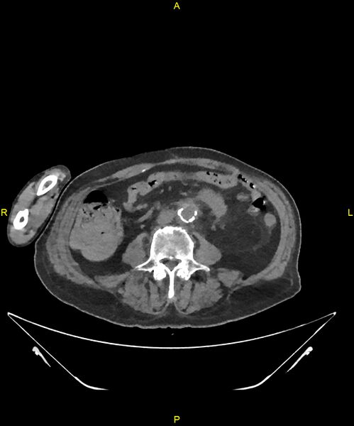 File:Aortoenteric fistula (Radiopaedia 84308-99603 Axial non-contrast 212).jpg