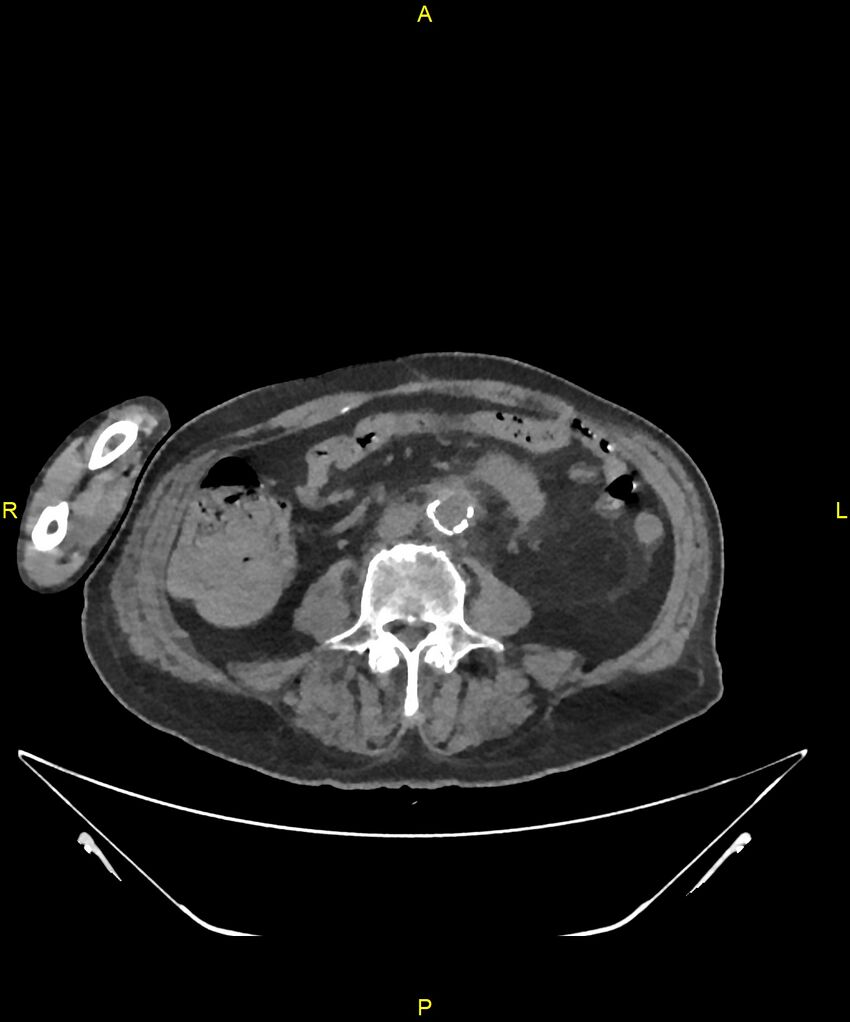 Aortoenteric fistula (Radiopaedia 84308-99603 Axial non-contrast 212).jpg