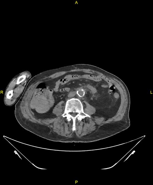 File:Aortoenteric fistula (Radiopaedia 84308-99603 Axial non-contrast 215).jpg