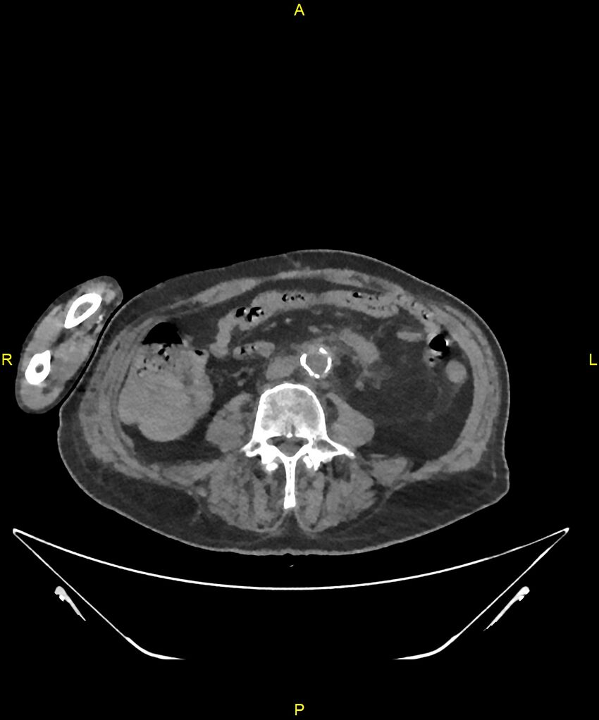 Aortoenteric fistula (Radiopaedia 84308-99603 Axial non-contrast 215).jpg