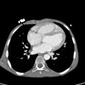 Aortopulmonary window, interrupted aortic arch and large PDA giving the descending aorta (Radiopaedia 35573-37074 B 53).jpg
