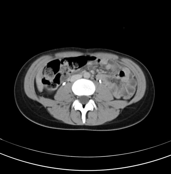 File:Appendicitis and incidental bicornuate uterus (Radiopaedia 22833-22853 Axial C+ delayed 18).jpg