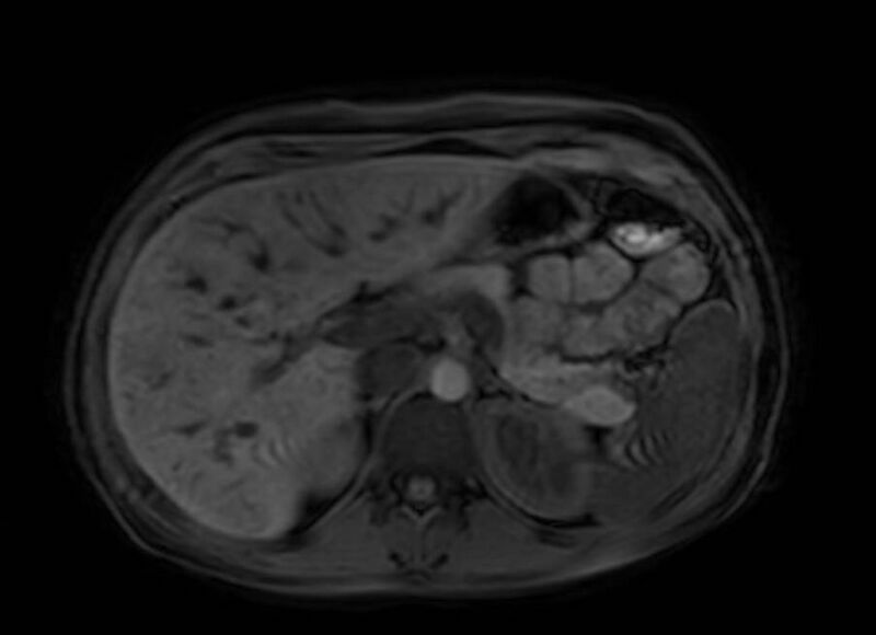 File:Appendicitis in gravida (MRI) (Radiopaedia 89433-106395 Axial DIXON 30).jpg